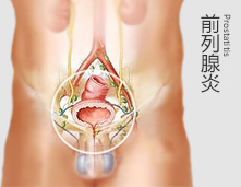 前列腺炎图片