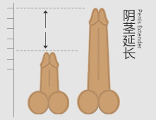阴茎延长图片