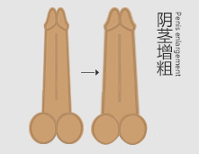 阴茎增粗图片