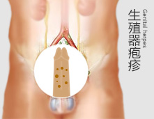 生殖器疱疹图片