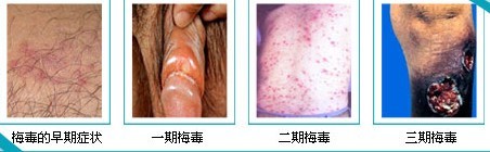 男性患有梅毒会怎么，会出现哪些症状？